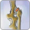 Osteoarthritis
